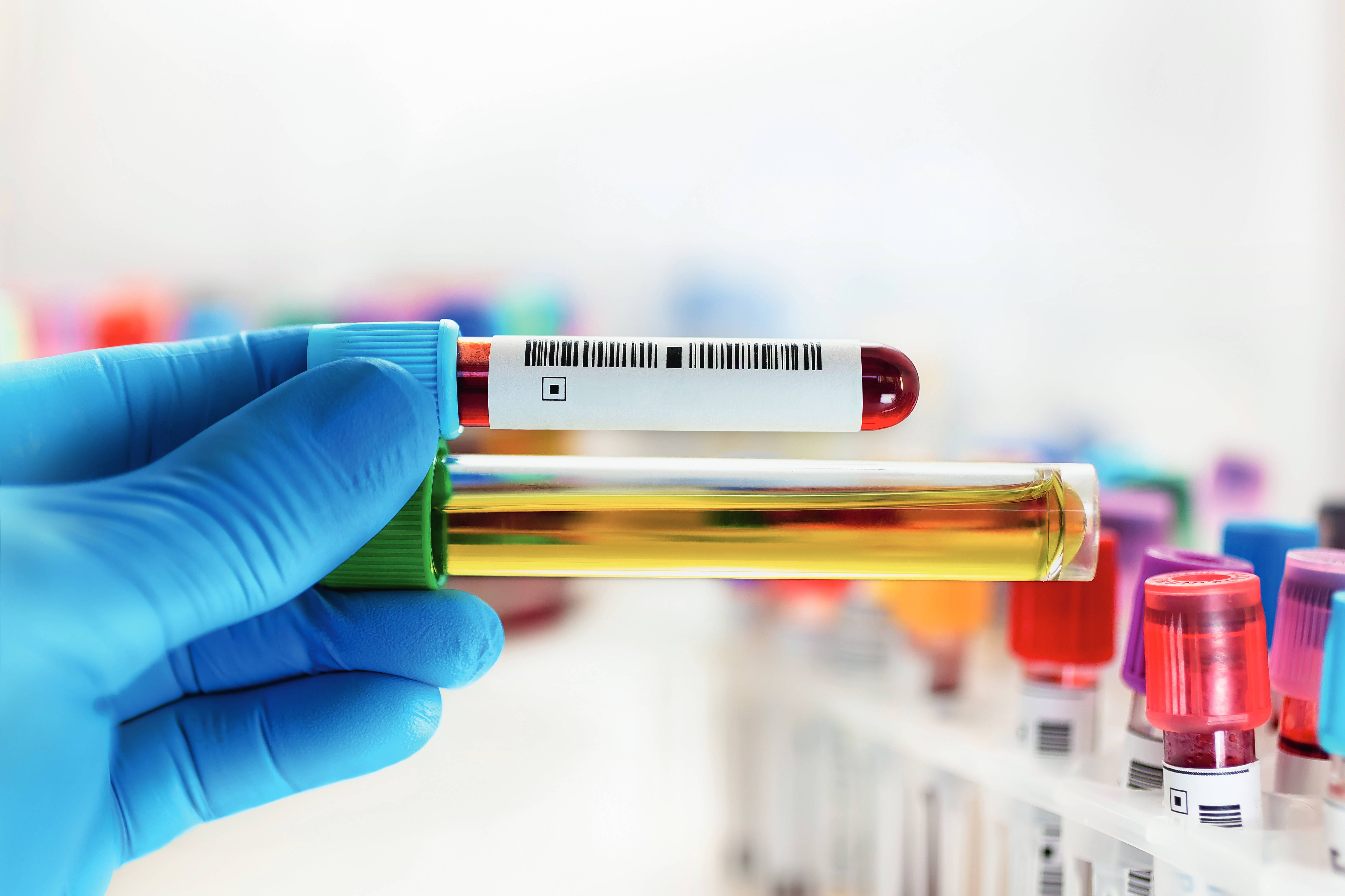 Så enkelt kan en folksjukdom upptäckas Så enkelt kan en folksjukdom upptäckas