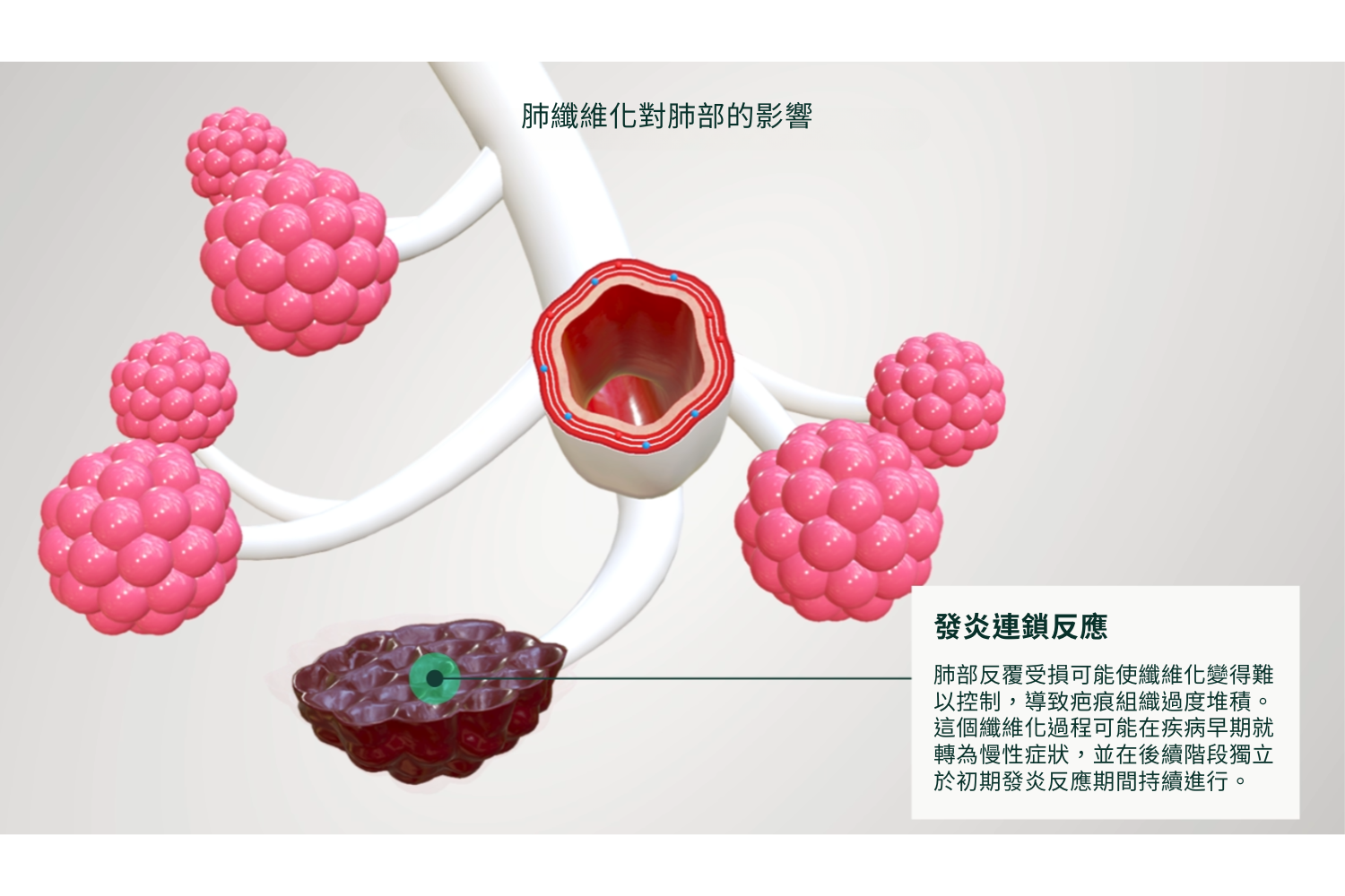 S8. EP14. 讓肺纖維化患者擁有更好的生活| Boehringer Ingelheim TW