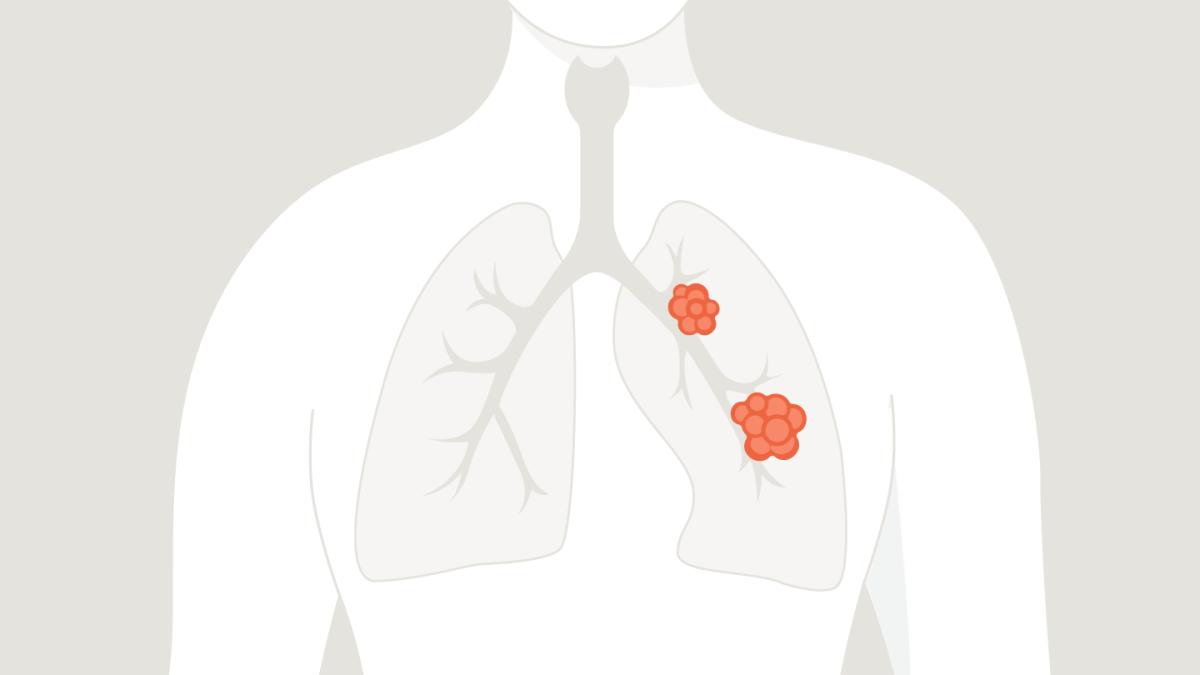 Comprender el cáncer de pulmón no microcítico (NSCLC) | Boehringer ...