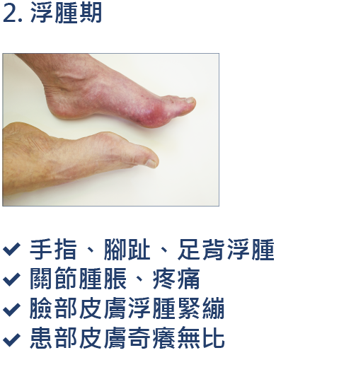 2020 世界硬皮病日：硬皮病懶人包 | Boehringer Ingelheim TW